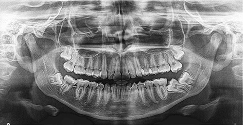 Exame Radiografia panorâmica - Radiologia Odontológica em BH