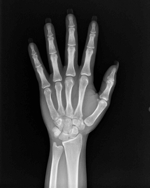 Exame de radiografia da mão e punho - Radiologia Odontológica em BH