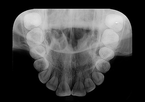 Exame radiorafia oclusal - Radiologia Odontológica em BH