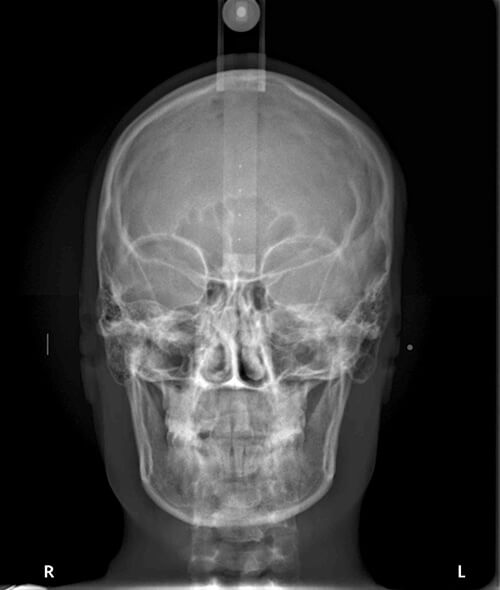 Exame telerradiografia frontal - Radiologia Odontológica em BH