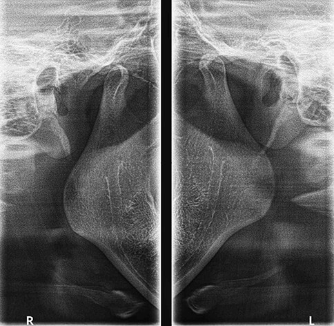 Radiografia de ATM (Boca fechada) - Radiologia Odontológica em BH